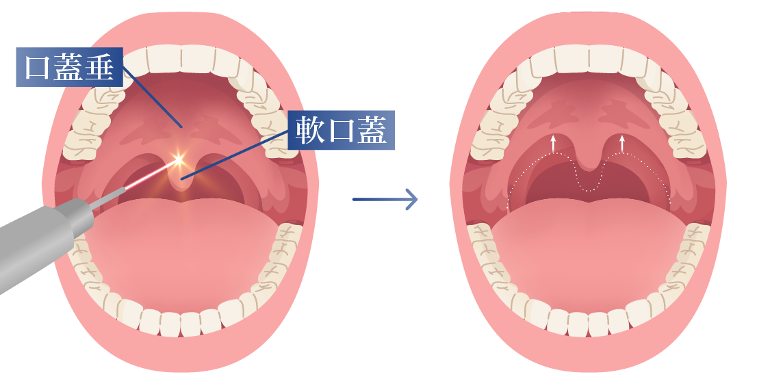 Dual NightLaseをあてている様子