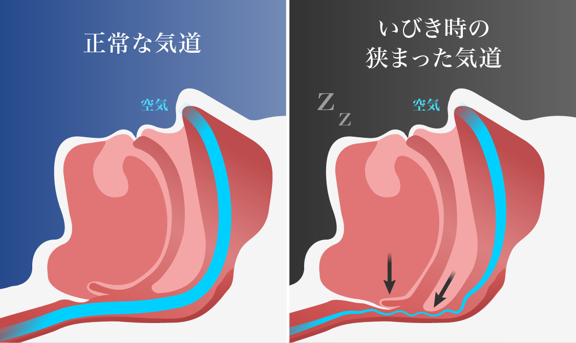 いびきを放置した場合のリスク