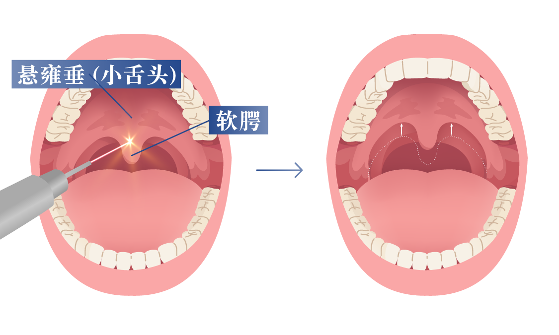 正在进行 Dual Deep Thermia 治疗的场景