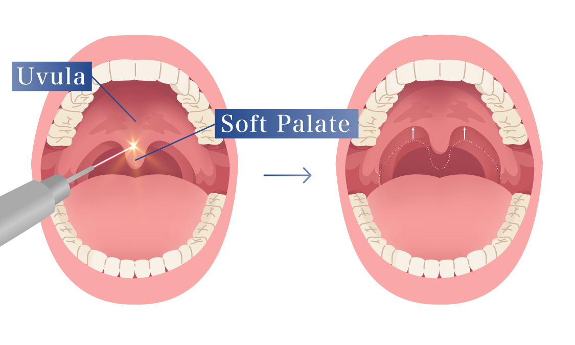 Treatment with Dual Deep Thermia