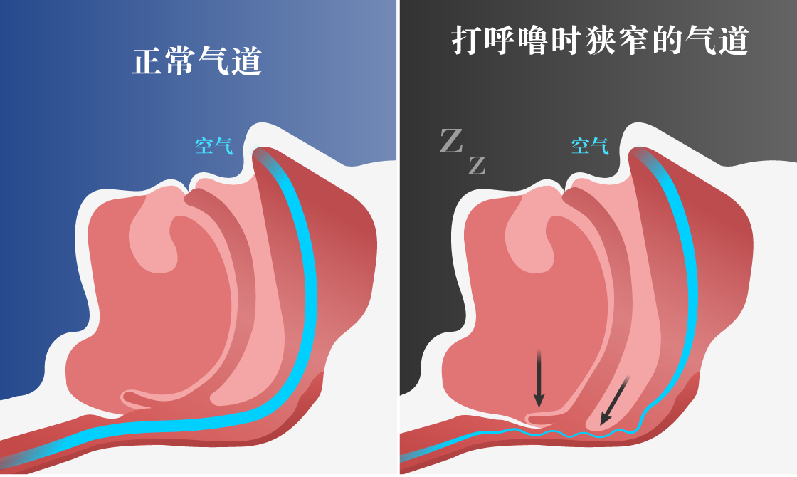 放任打呼噜不管的风险