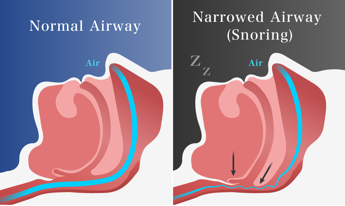 Risks of untreated snoring