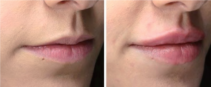 LipLaseのbefore&after