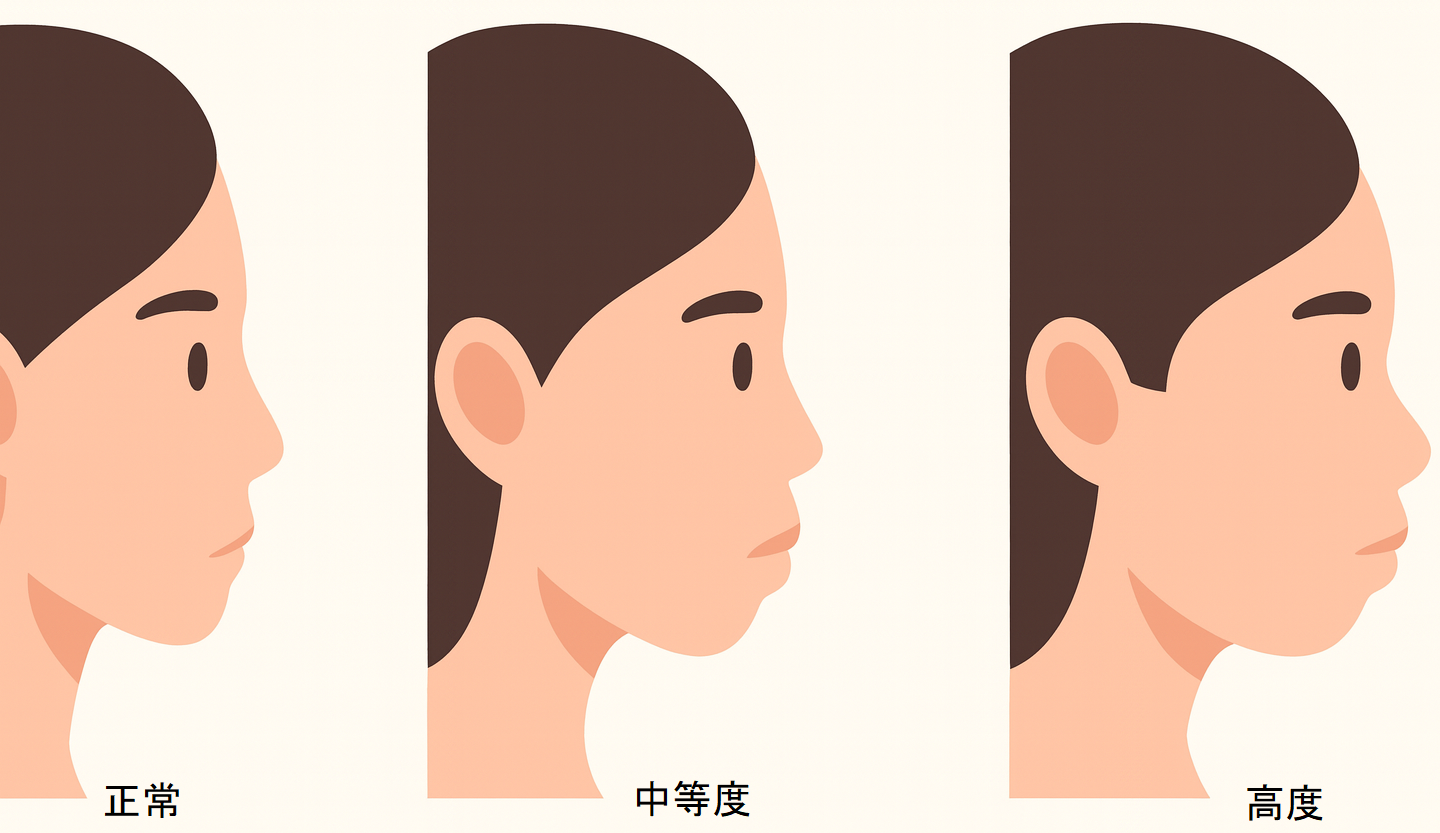 いびきの人は首が太い