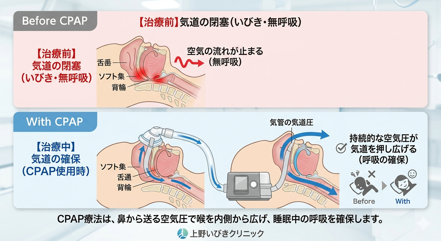 cpapの原理　どのような機械か