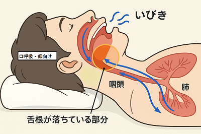 いびきは舌が落ち込んで発生することが多い