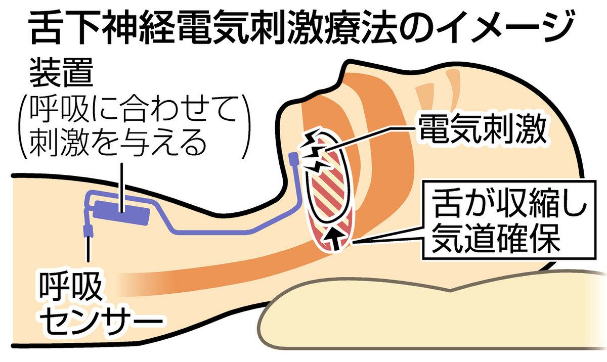 舌下神経刺激植え込み