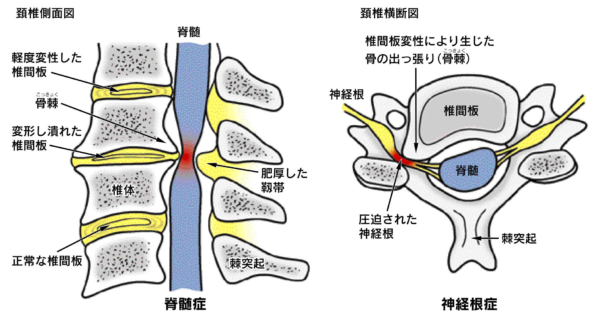 脊柱 管 狭窄 症