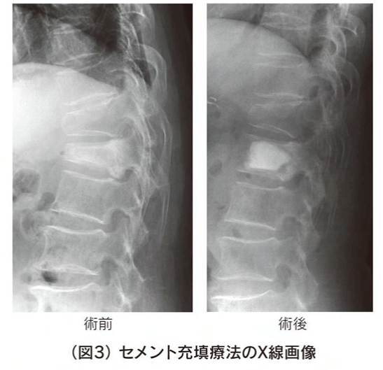 脊椎椎体圧迫骨折(胸椎・腰椎圧迫骨折)とは(原因・症状・診断検査・予防・治療法など) 池袋西口病院(旧平塚胃腸病院) 脊椎椎体圧迫骨折(胸椎・腰椎圧迫骨折)とは(原因・症状・診断検査・予防・治療法など) 池袋西口病院(旧平塚胃腸病院)