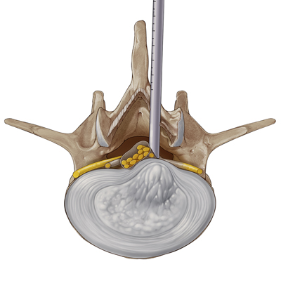 経皮的内視鏡下腰椎椎間板摘出術（PELD/PED)
